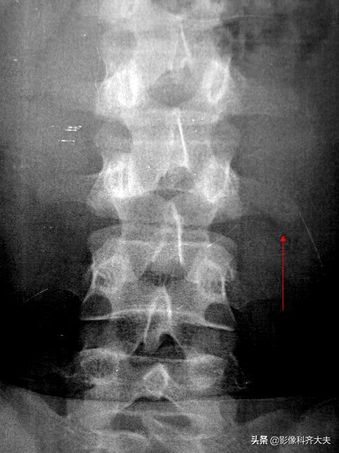 骨折的影像学检查及各自的优势,骨折的影像学愈合标准