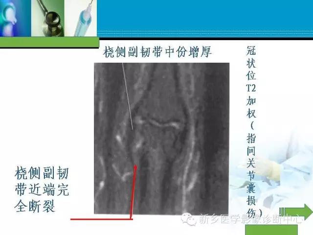 单只手指磁共振,手指用磁共振能做出来结果吗
