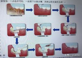 健康科普堂冬季,阻生齿对人体有哪些影响