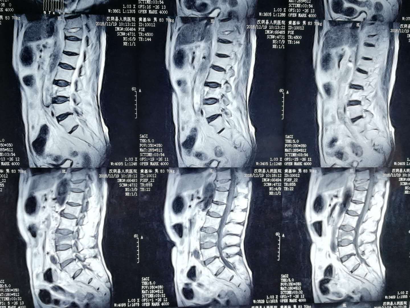 汉阴县中医医院微创手术治疗骨质疏松型骨折