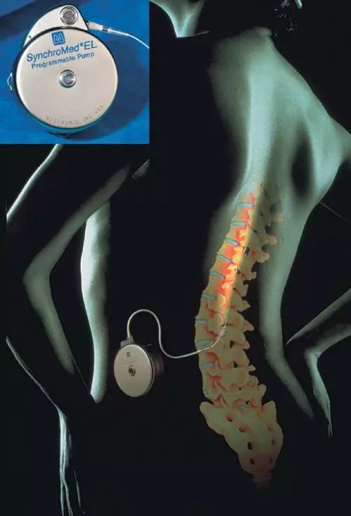 下肢截瘫康复成功案例,全国治疗截瘫最新突破