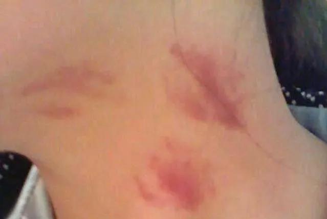 宝妈满脖子“草莓”去接孩子放学,被大娘追问是不是上火