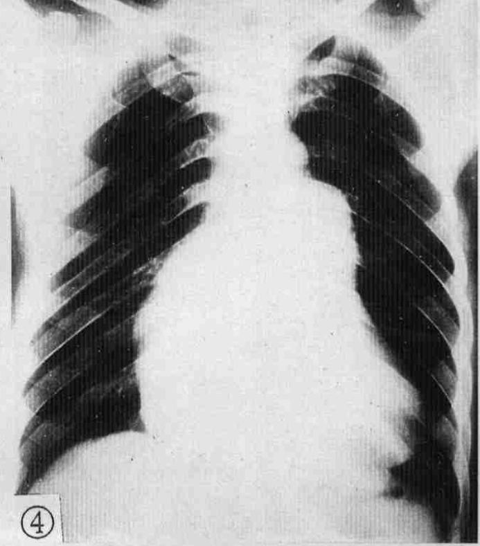 循环系统胸片,体循环和肺循环临床表现