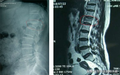 老人摔小腿骨折要手术吗,老年人腰椎压缩性骨折需住院多久