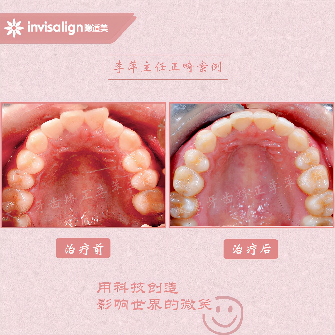 太原牙齿矫正拔牙拔六颗有危害吗,太原牙齿开合矫正