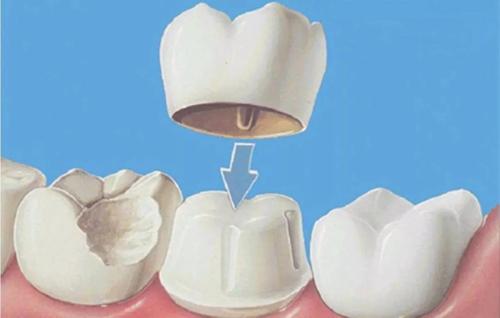 全烤瓷牙有什么风险和后遗症,做烤瓷牙有什么危害