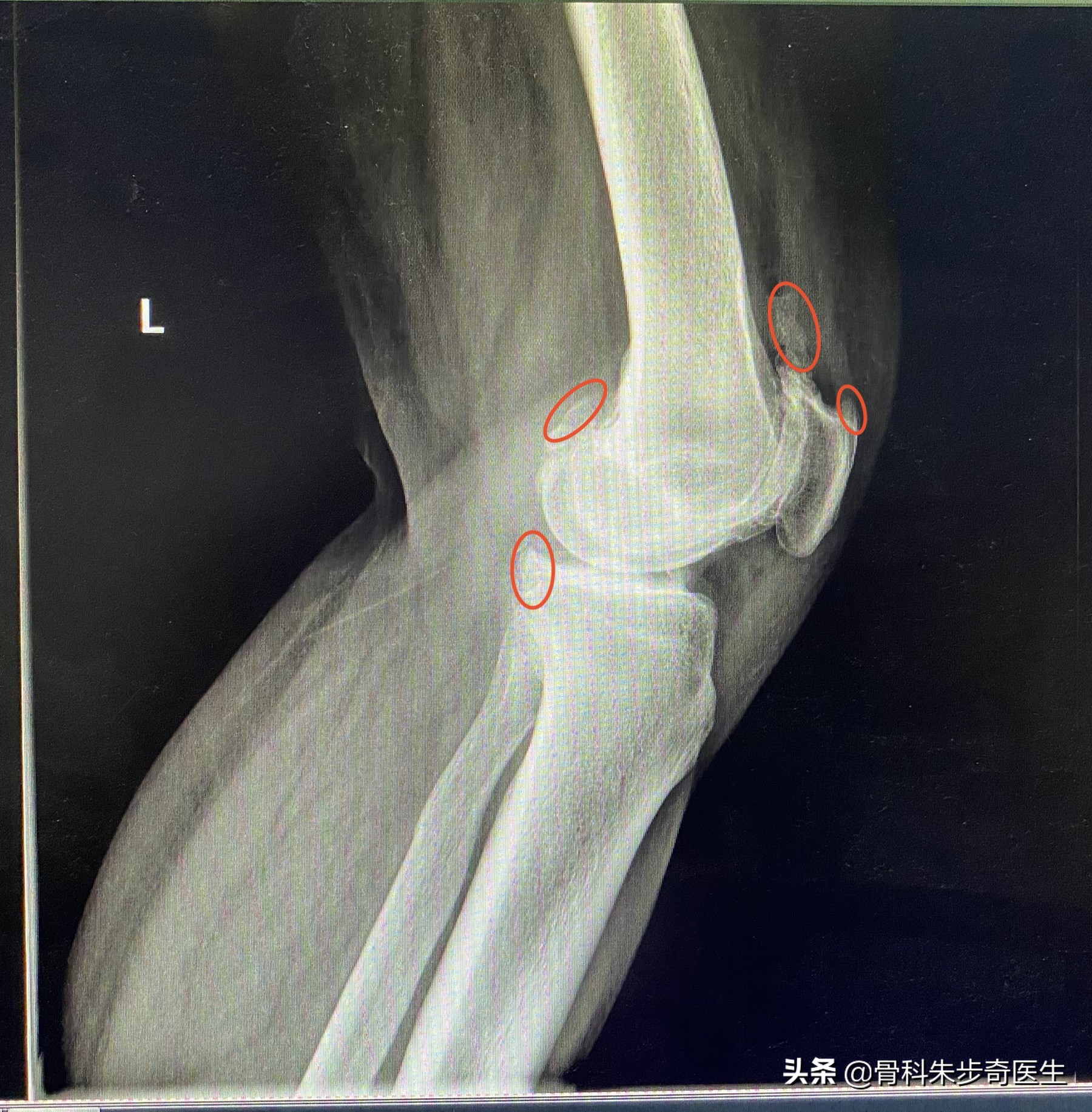 膝关节有骨刺应该怎么治,早期膝关节有骨刺怎么能治愈