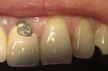 烤瓷牙崩瓷的正确处理方法,烤瓷牙崩瓷了怎么修