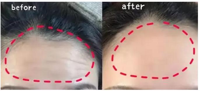 硬刚女皇龙妈也扛不住法令纹,2条沟壑让人心疼,贴一贴就消了