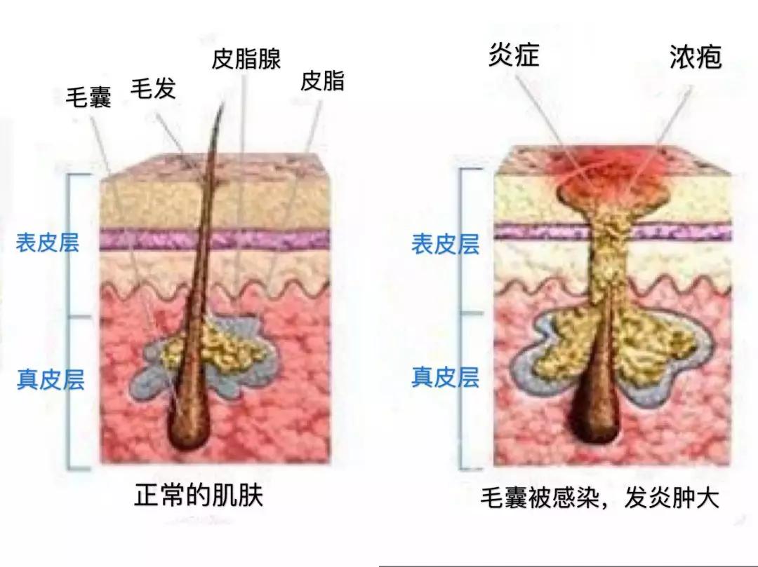 红痘印和黑痘印该怎么祛除,红痘印黑痘印都可以用的药膏