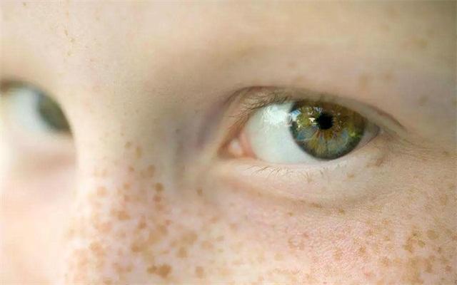 常见的色斑种类图文,脸部常见斑种类及图片