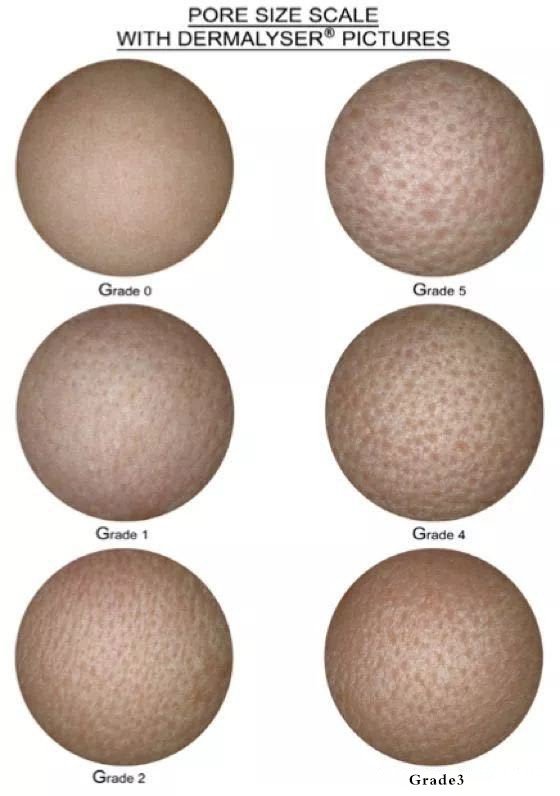 怎么拯救毛孔粗大堵塞,如何拯救已经粗大的毛孔