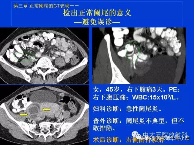阑尾炎课件,阑尾炎的超声课件