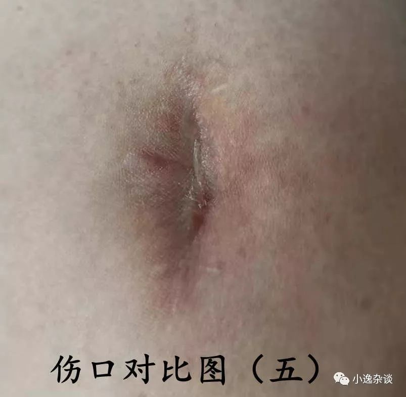 皮肌炎回忆录（十）