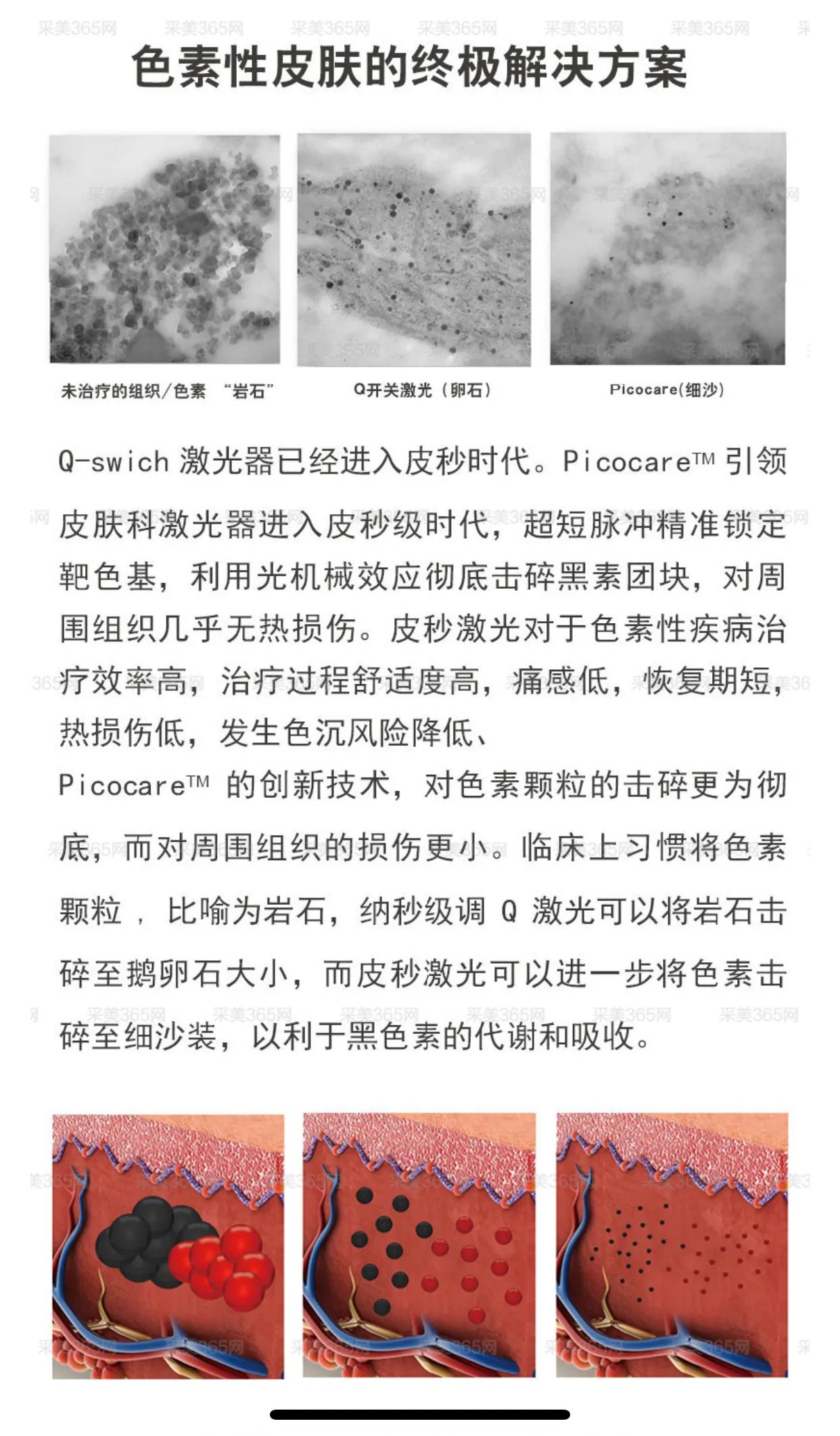 激光祛斑产品排行榜10强,cfda祛斑仪器