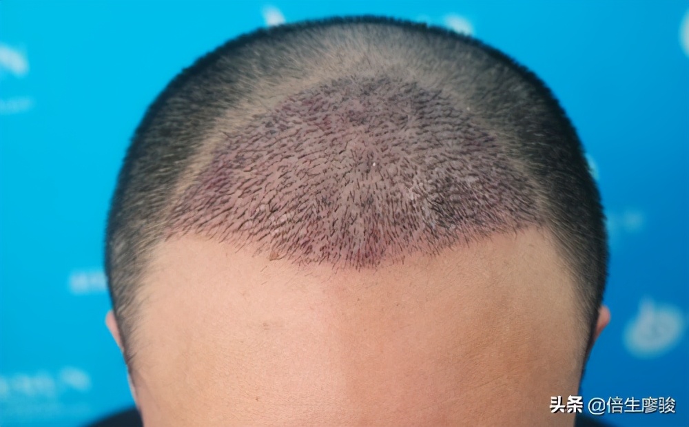 植发对额头的修饰,植发改善秃子