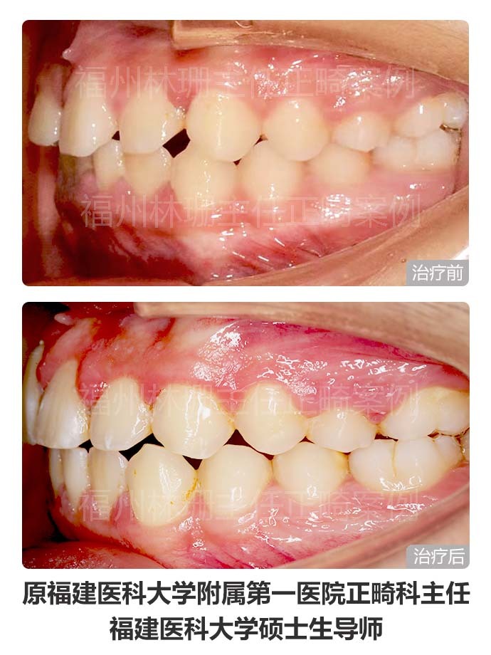 牙齿矫正仍然没整齐,异位正常牙齿矫正不过来怎么办