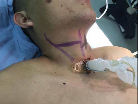 29岁男子车祸送医，神经外科“一站式”救治颅脑和脊柱脊髓复合伤