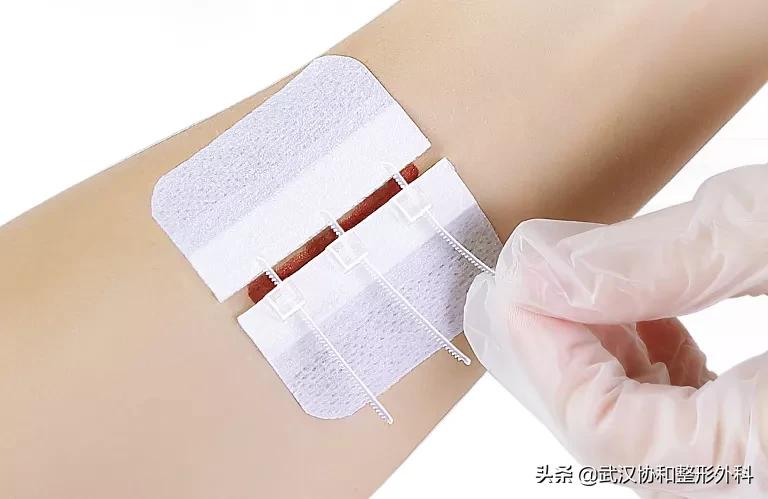 手术后怎么预防疤痕用什么药膏,预防疤痕增生最佳方法