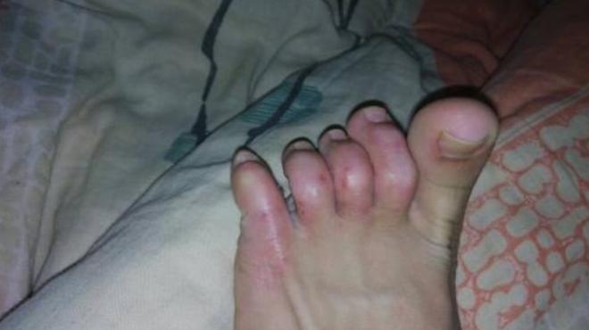 医生有阴虱是怎么回事,男性下身有虫子不治可以吗