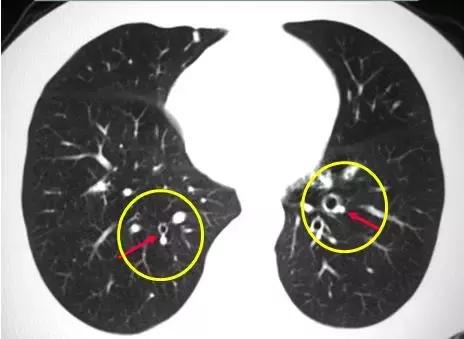 肺部ct十大征象,肺部ct正常图和异常图的区别