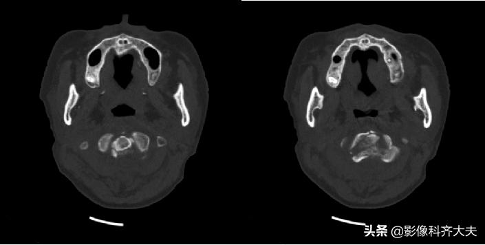 骨折的影像学检查及各自的优势,骨折的影像学愈合标准