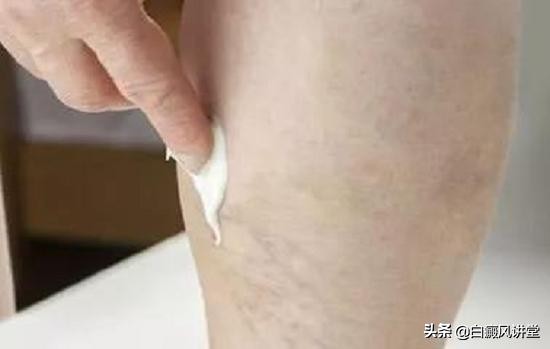 白癜风患处能抹防晒霜吗,白癜风的患处抹皮炎平吗