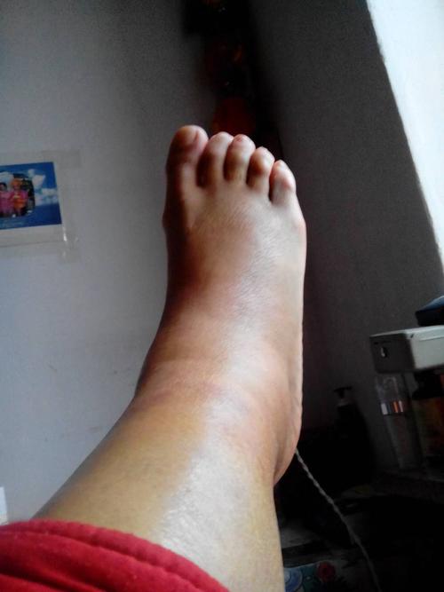 崴脚了正确的处理流程,轻微崴脚之后需要怎么做