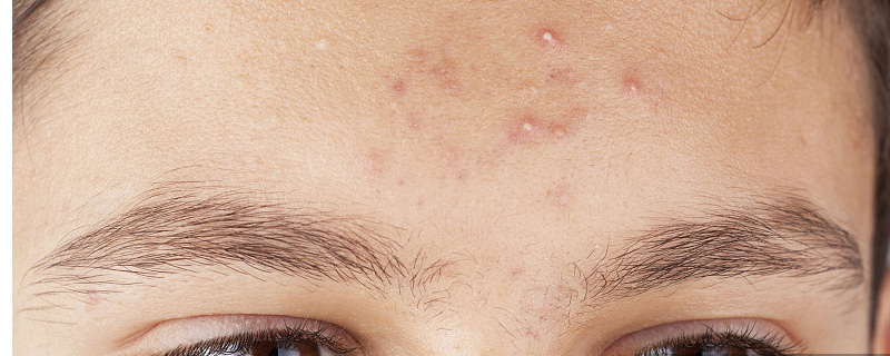 额头长痘丹栀逍遥丸治疗痘痘吗,额头长痘怎么快速消除不用药膏