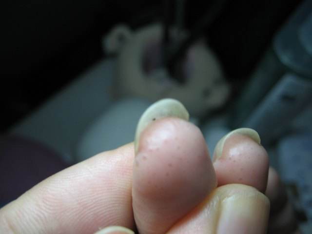 脚上手上长透明小水泡是什么原因,手上胳膊上有很多透明小米粒水泡