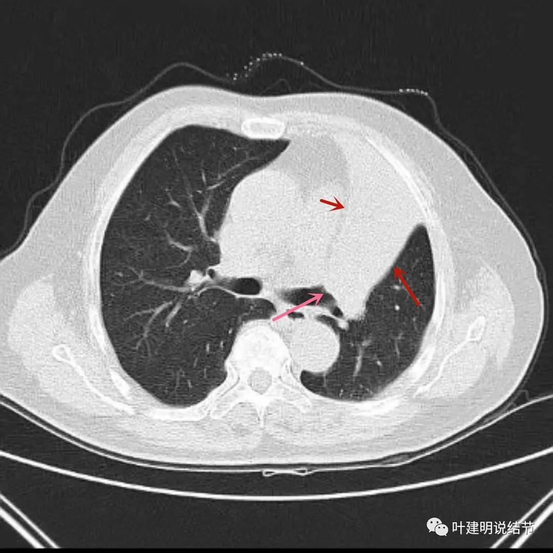 高龄肺癌靶向治疗效果,高龄老人肺癌早期适合放疗吗