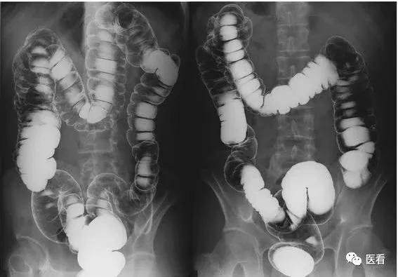 这就是空腹拍片的原因！听医生的话别让他受伤......