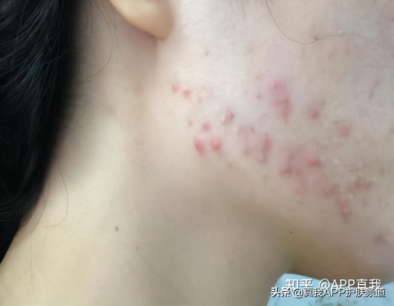 学生长脓痘怎么办,高中生长痘痘怎么防止