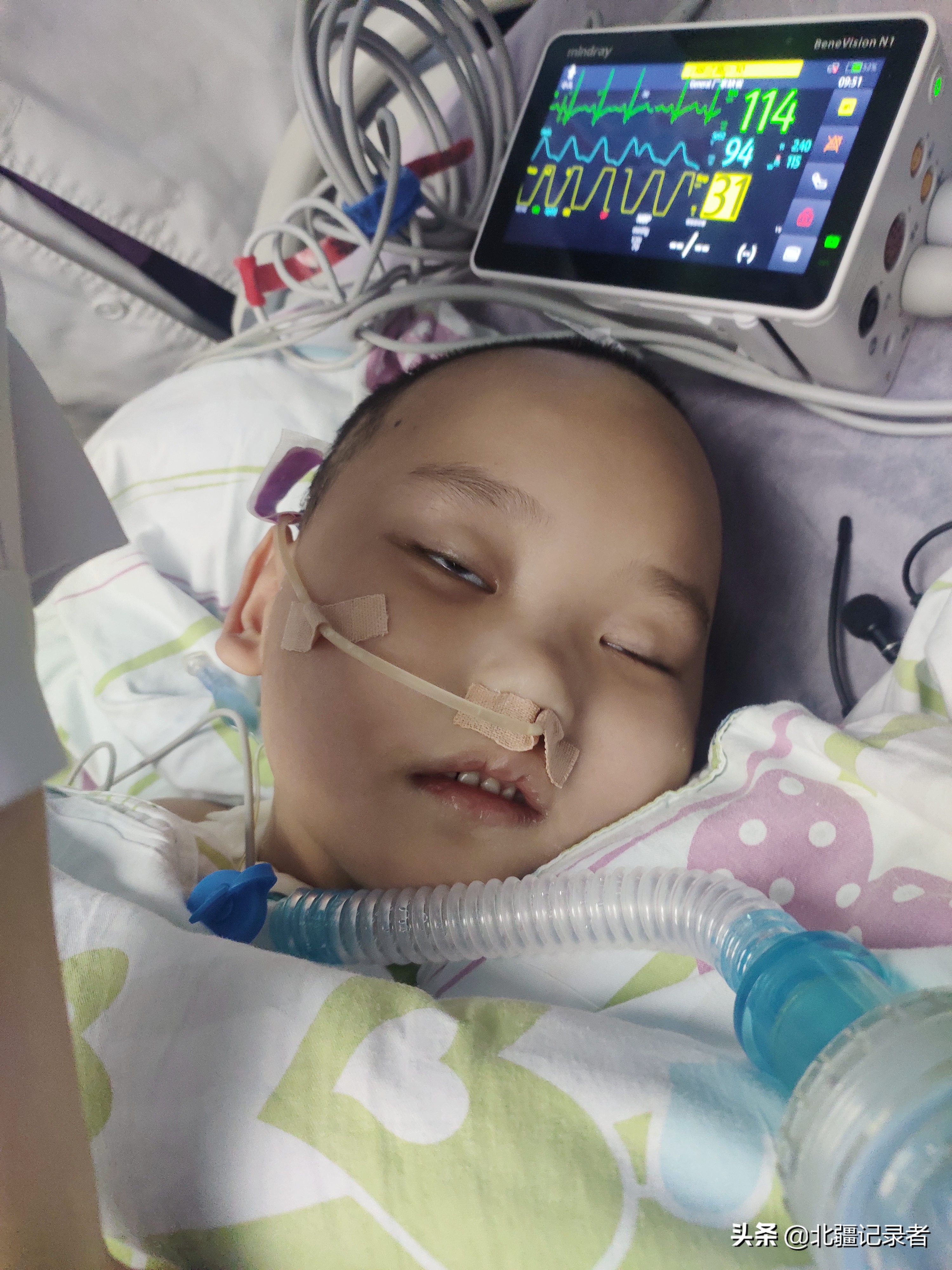 小孩咳嗽厉害突然死亡,孩子因为支气管肺炎住院的视频