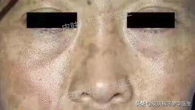 色斑和褐斑,根治面部黑褐斑的方法