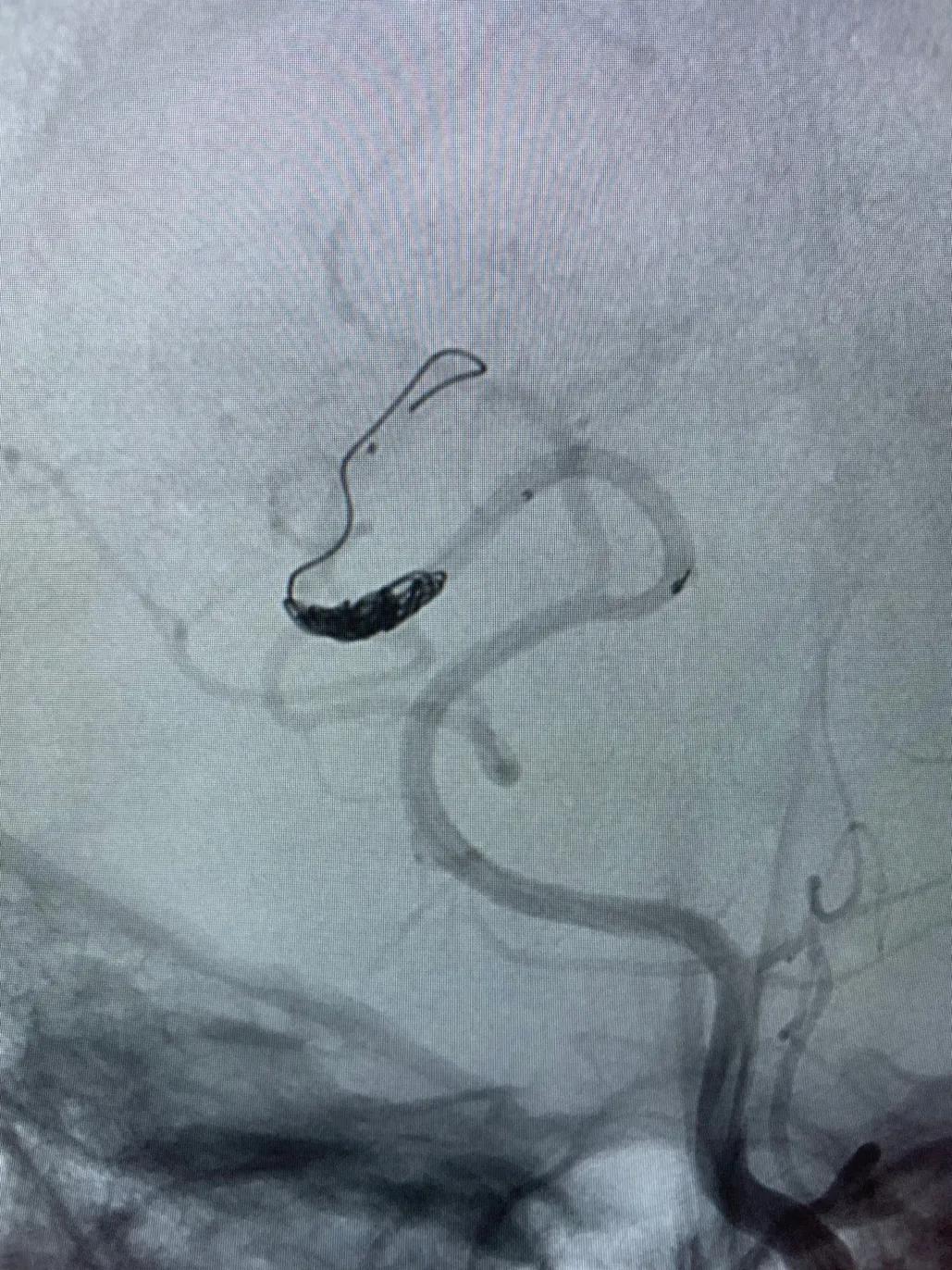 脑动静脉畸形介入栓塞手术的风险,介入栓塞技术在脑avm治疗中的作用