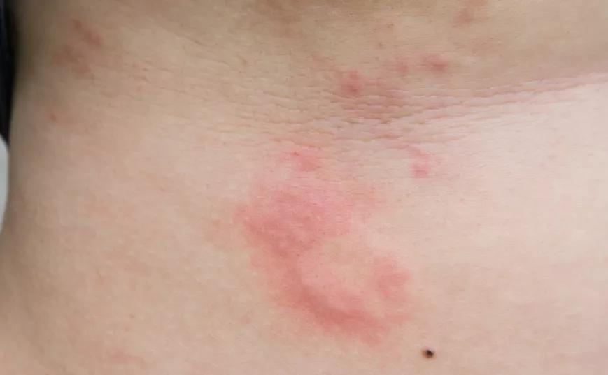 皮肤病反反复复怎么办才好,皮肤病很痒怎么办