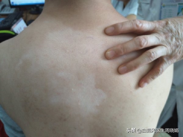 「不慌~」脸上长了这种白斑别慌！医生让你这么做