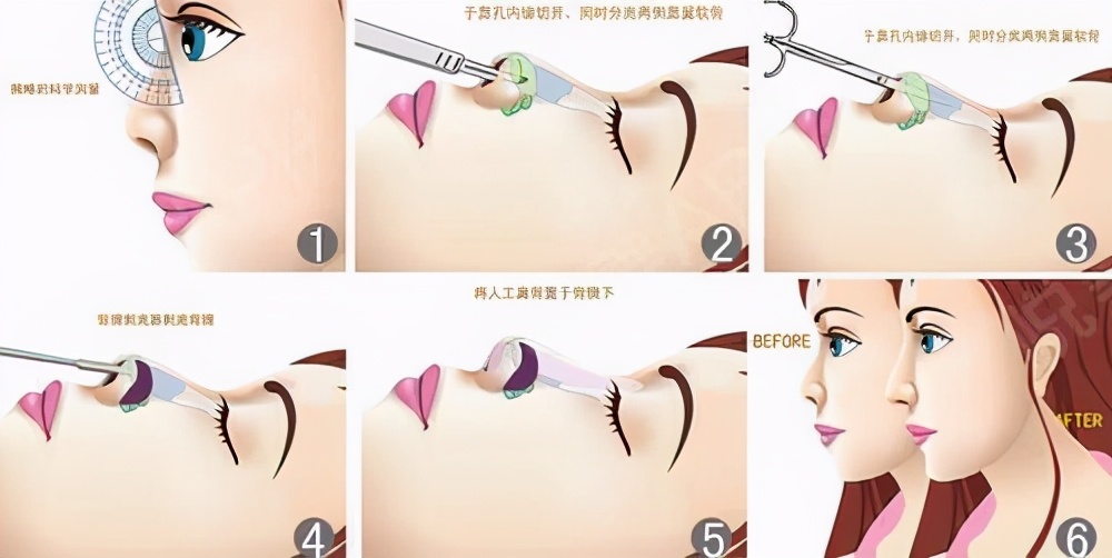 鼻子整形难看吗,鼻子丑只能整吗