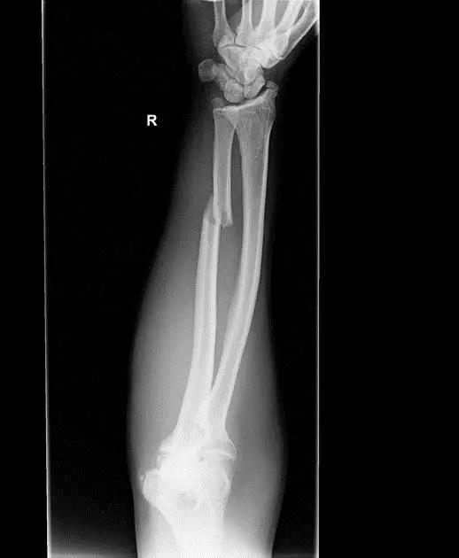 几种严重骨折医学名称,常见的骨折有哪些名称