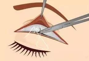 割双眼皮埋线和全切有什么区别,全切双眼皮内眼角割的不一样