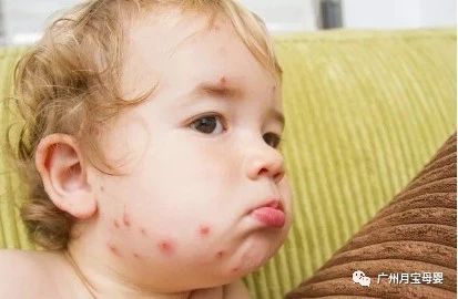 新生婴儿溶血性黄疸怎么照顾,新生儿溶血性黄疸护理月嫂