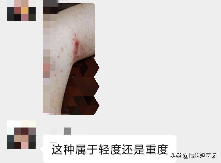 服用靶向药引起甲沟炎如何痊愈,靶向药导致的甲沟炎怎么处理