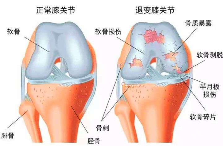 膝关节弹响的原因及治疗方法,膝关节有弹响