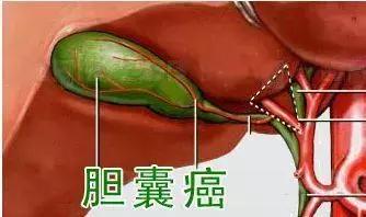 脸颊反反复复长痘就是有炎症,脸上像打了腮红一样是什么原因