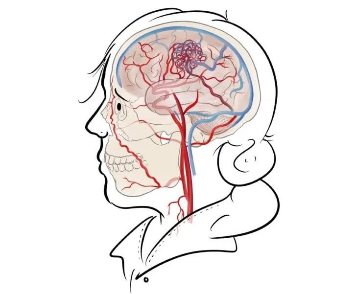 儿童脑血管畸形保守治疗方法,脑血管畸形加动脉瘤保守治疗