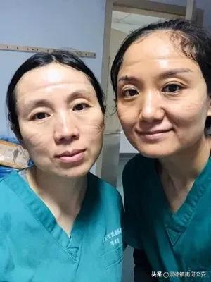 女医护脸上勒痕,最美护士脸上勒痕