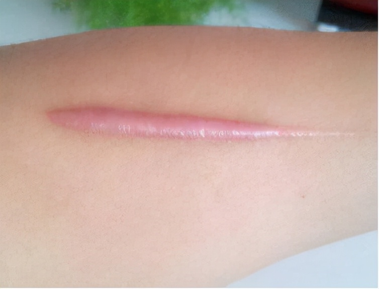 刀口增生会自动恢复吗,剖腹产刀口增生了怎么消除