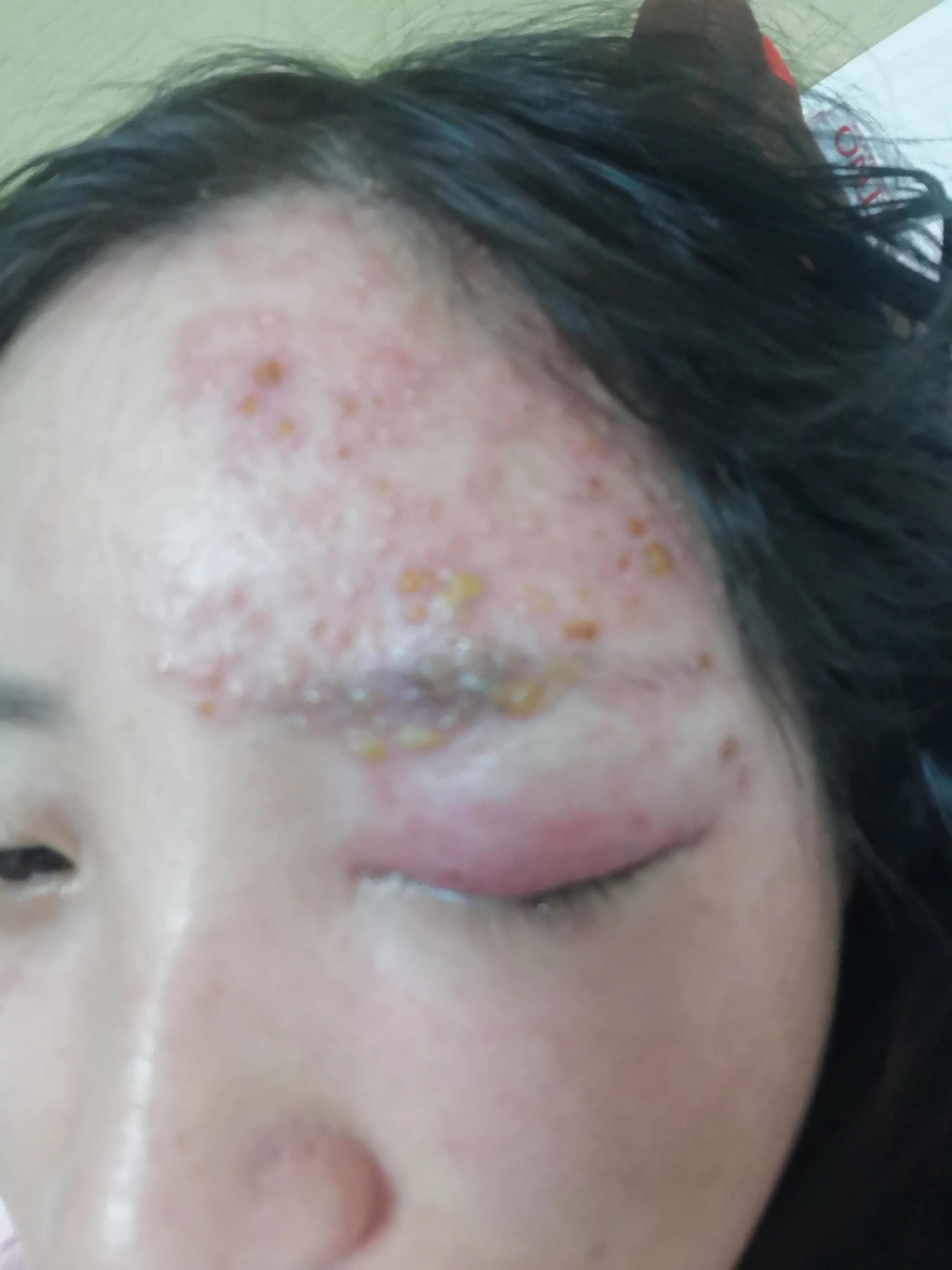 孕妇得了带状疱疹病毒怎么办,孕中期得带状疱疹该怎么办