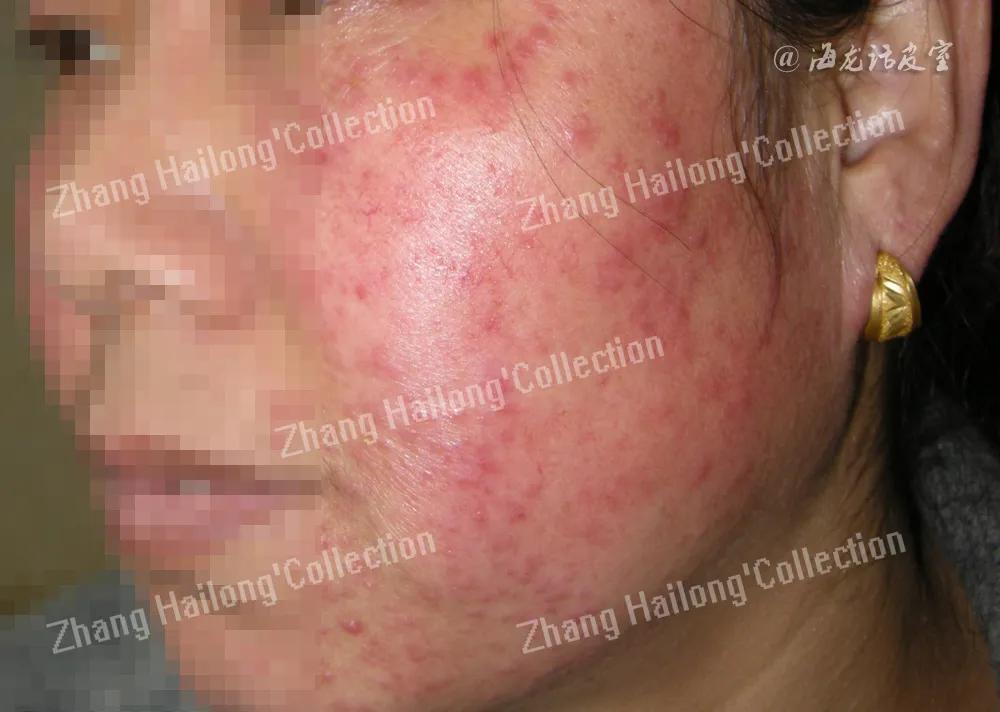 激素依赖性皮炎饮食注意事项,激素依赖性皮炎用什么护肤品